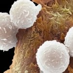 leukemia 1