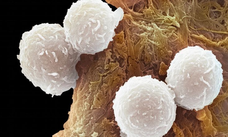 leukemia