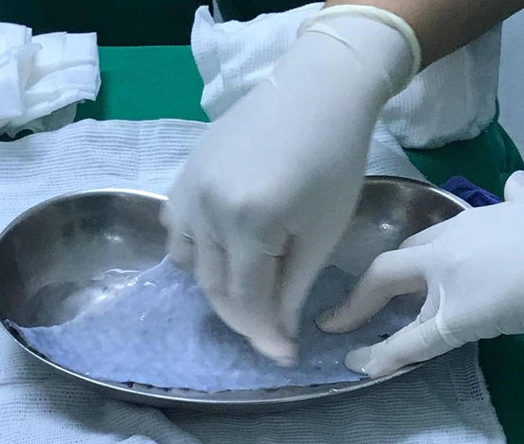 Γυναίκα που γεννήθηκε χωρίς κόλπο απέκτησε γεννητικά όργανα από δέρμα ψαριού 7 v23aeira