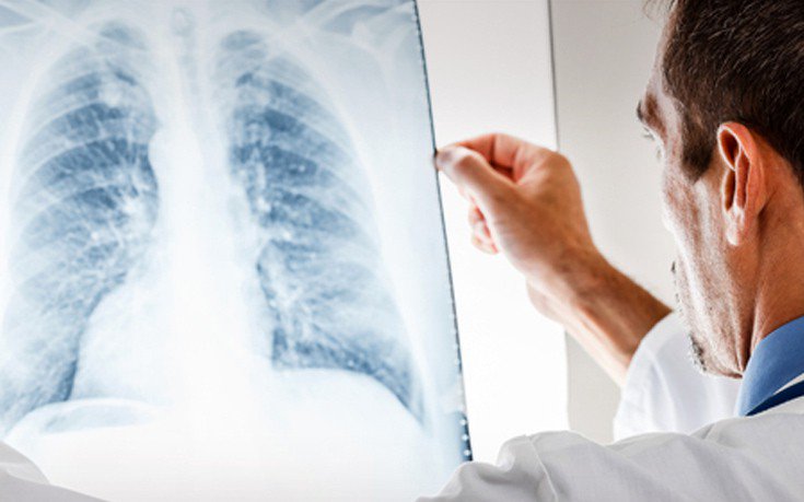 lung