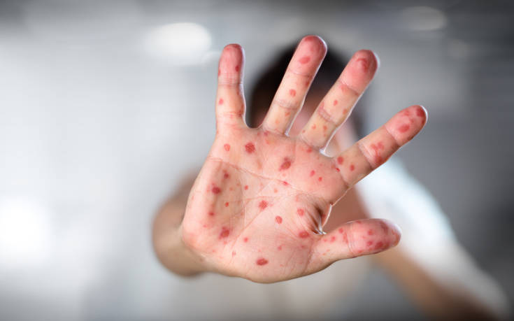 Αναζωπυρώθηκε η ιλαρά σε όλο τον κόσμο 4 shutterstock550598923