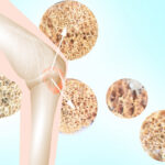 multiple myeloma pollaplo shutterstock 1723561474