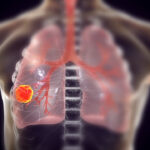 lung cancer shutterstock 1062330314