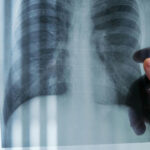 Καρκίνος πνεύμονα: αντιμετώπιση με Θωρακοσκοπική Χειρουργική VATS