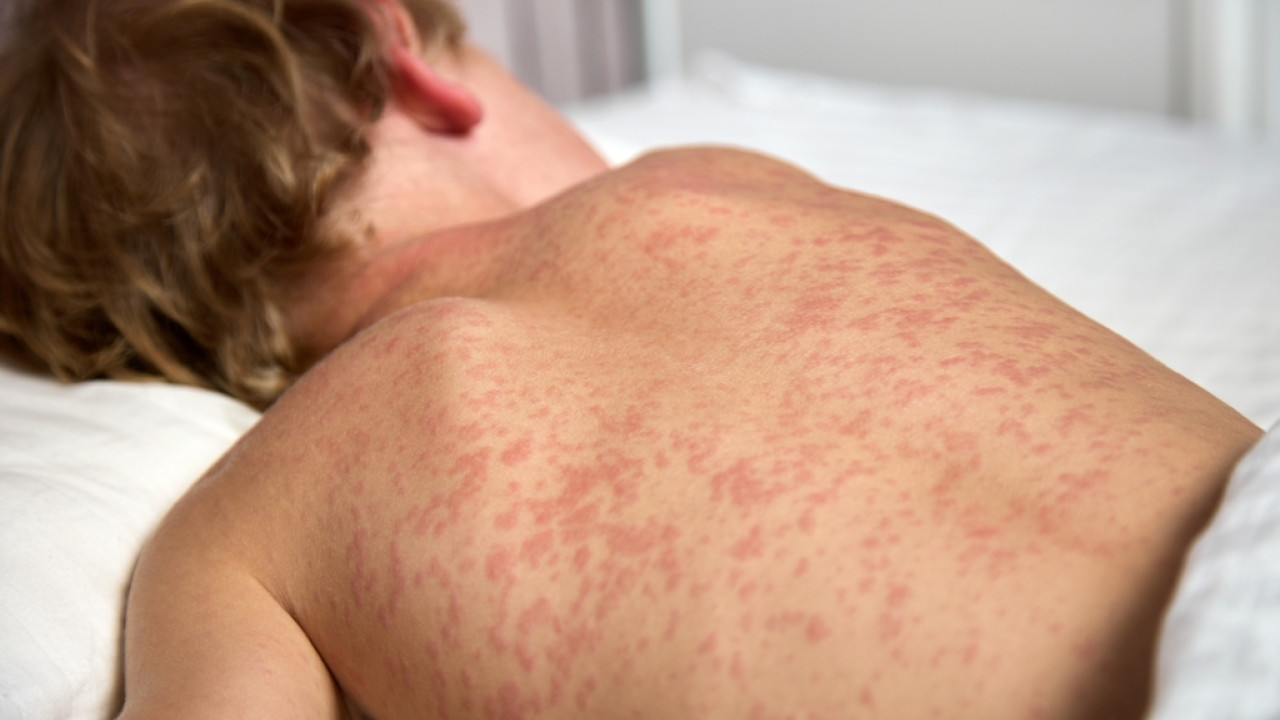 measles ilara shutterstock 2236377037