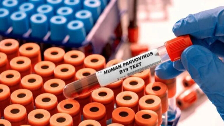 Παρβοϊός: Επτά ερωτήσεις και απαντήσεις για τη λοίμωξη από την Ελληνική Εταιρία Λοιμώξεων
