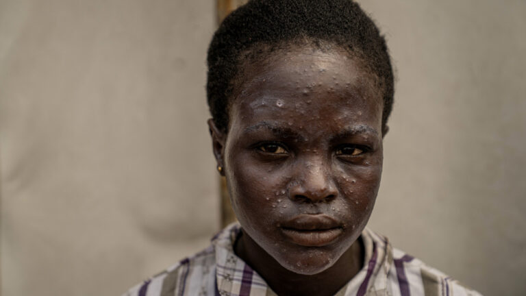 ΠΟΥ: Προμηθεύει εκτάκτως Gavi και Unicef με εμβόλια κατά της mpox