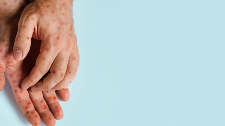 Μpox – ΠΟΥ: Συνεδριάζει η επιτροπή αντιμετώπισης κρίσεων για την ευλογιά των πιθήκων