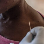 mpox ape