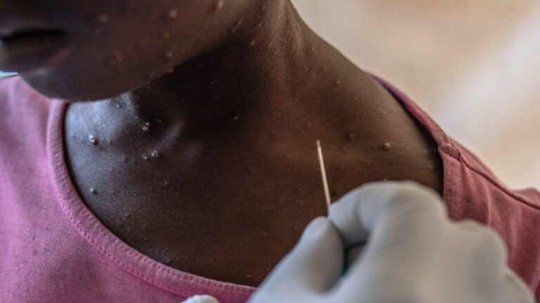 Mpox: Ο ΠΟΥ ενέκρινε το 1o τεστ για γρήγορη διάγνωση