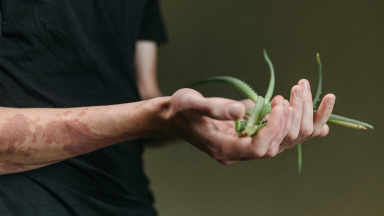 Ψωρίαση Δέρματος: Που βρισκόμαστε σήμερα;