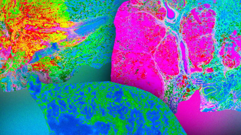 Καρκίνος του πνεύμονα: Μείωση των θανάτων με τον προσυμπτωματικό έλεγχο