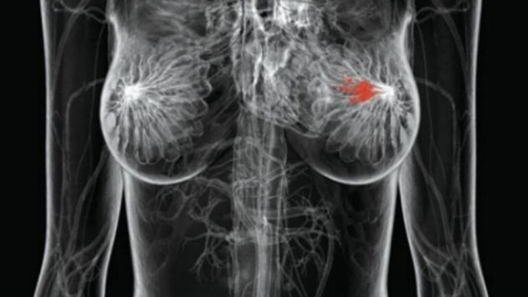 Καρκίνος του μαστού: Η τεχνητή νοημοσύνη εντοπίζει γυναίκες που κινδυνεύουν πολύ πριν τη διάγνωση