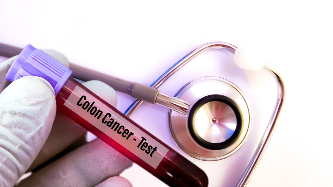 st colon cancer test